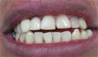 "How Old U Have to Be to Take Viagra